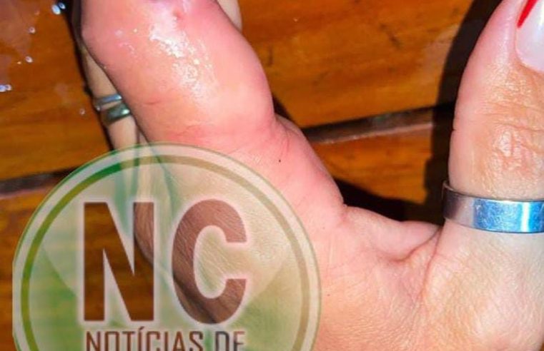 MAIS UM CASO: com dedo bastante inchado, mulher procura sede do Águia Resgate para retirada de anel em Conceição do Coité