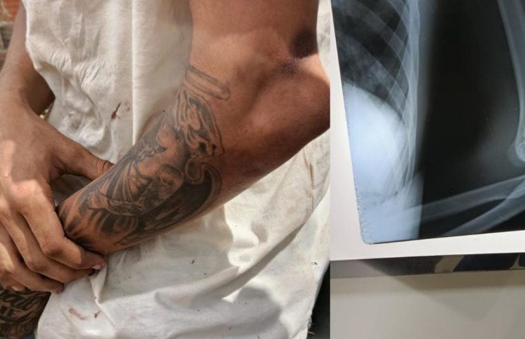 Novo acidente! Homem tem fratura confirmada no cotovelo após acidente de moto em Conceição do Coité